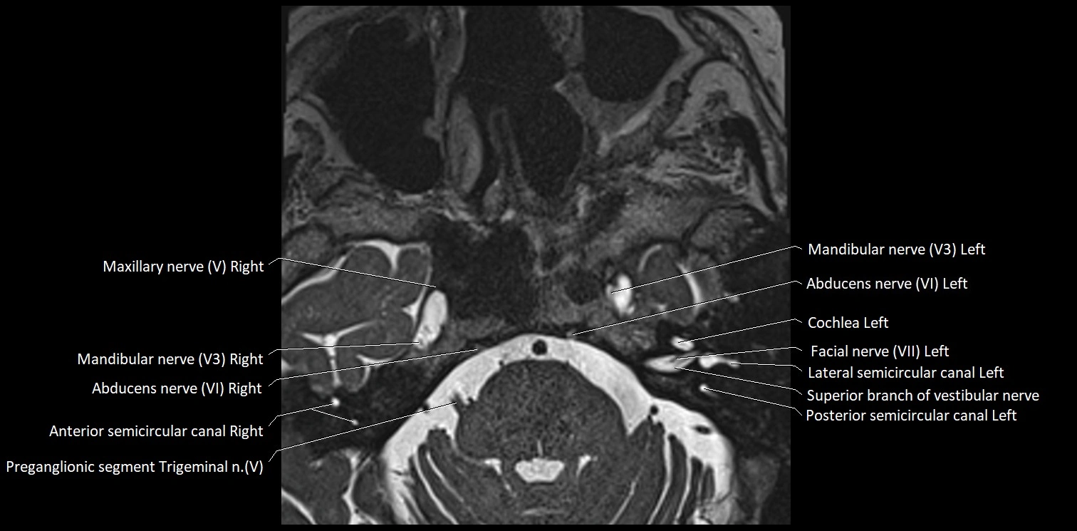 Cranial nerve anatomy axial MRI 3T image 47.webp
